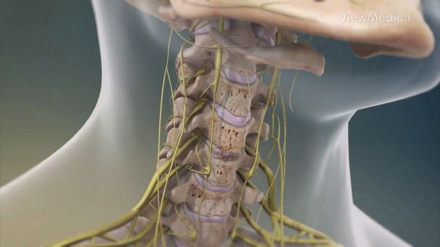 Discectomía y Fusión Cervical